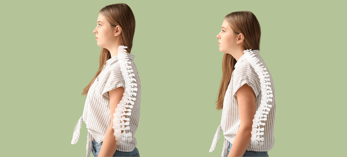 Hyperlordose : Comprendre et soigner la lordose lombaire | Blog Levalor ...