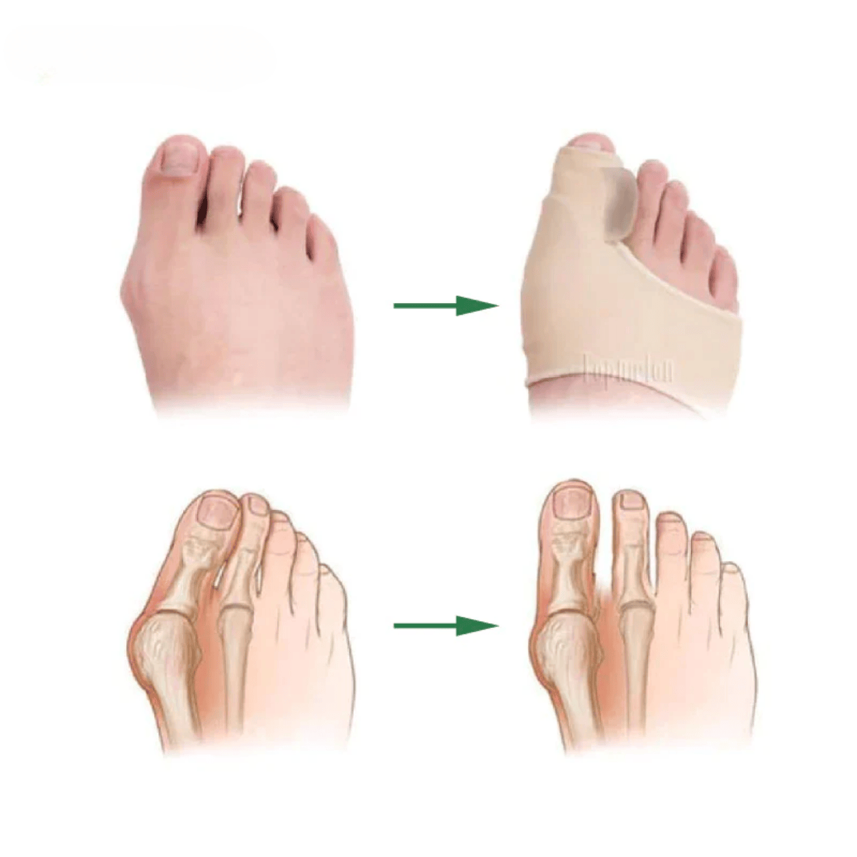 Orthèse Hallux orthese hallux valgus orthèse hallux valgus hallux valgus orthèse orthèse hallux valgus efficace orthese hallux valgus remboursé orthèse hallux valgus remboursé orthese hallux valgus nuit orthese hallux valgus silicone Oignon Orteil Levalor